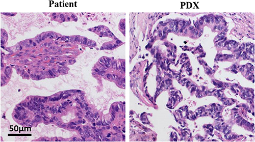 Figure 2 The PDX models are consistent with the histological. Tumor tissues from patient (NO.11) and the P4 generation PDX model were fixed and examined with H&E staining.