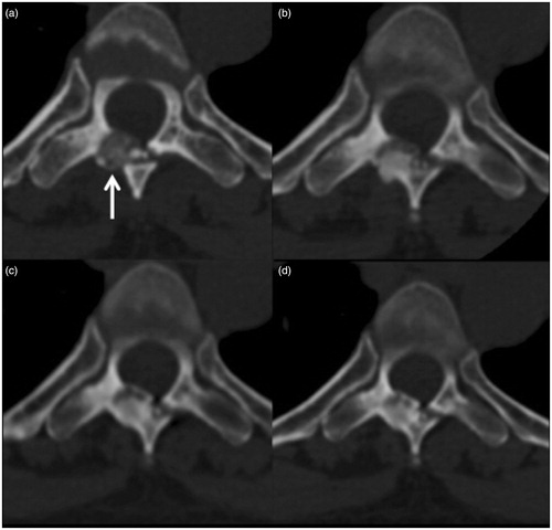 Figure 2. OB (arrow) of the posterior arc of D6: (a) before treatment; (b) follow-up 6 months after treatment showing sclerosis of the lesion; (c, d) follow-up after 24 and 60 months, respectively, showing the slow progression of bone remodelling toward disappearance of the treated lesion.