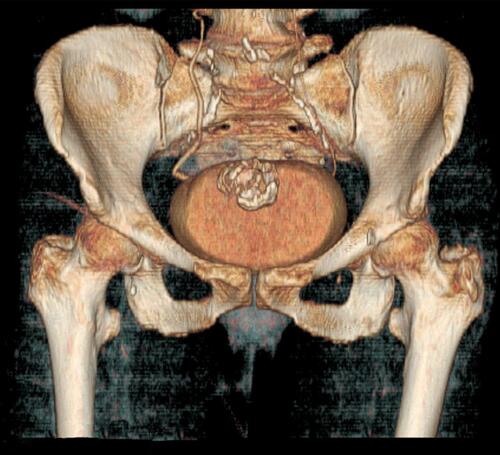 Figure 2 3D CT reconstruction showing the topographic contiguity of the calcified lesion and bladder wall.