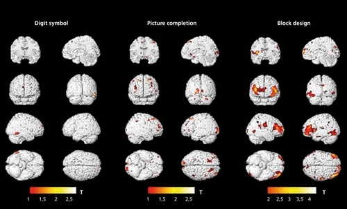 Figure 3. Correlations between regional gray matter and digit symbol scores, picture completion, and block design (N =48). Color bar shows t values; maximum r=0.36:0.39:and 0.57 respectively