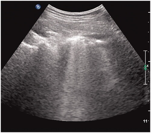 Figure 2. Thoracic ultrasound scan of a pregnant woman infected with Listeria monocytogenes in the second trimester.