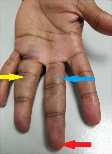 Figure 1 Bruising of the proximal and middle phalanges of middle finger (blue arrow) and ring finger (yellow arrow) with apical sparing (red arrow).