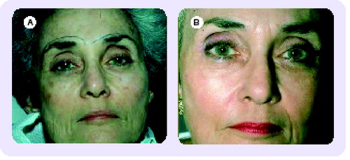 Figure 3. Monheit combination peel.(A) Preoperative, (B) Postoperative.