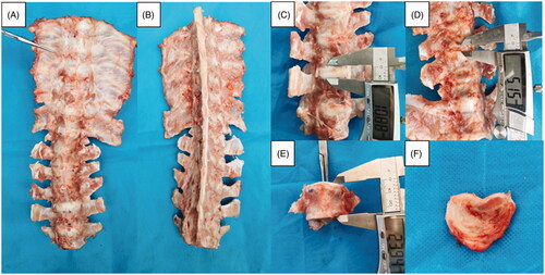Figure 9. Asymmetric segmental spine growth and structural scoliosis at 6 weeks after the operation in piglets with MWA. (A,B) Spine in the neutral position showing mild scoliosis. (C,D) Dysplastic disk annulus fibrosus on the ablated side, and normal contralateral side. (E) Significant wedge-shaped changes in the vertebral bodies. (F) Intervertebral disk dysplasia on the ablated side and normal contralateral side.