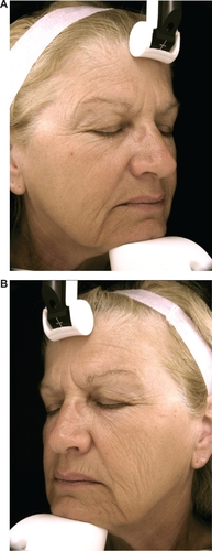 Figure 7 Photographs of subject number 8 (female) who had spent nearly half her life driving a car two hours per day to go to and from work. A) Nonwindow-exposed side (her right side). B) Window-exposed side (her left side) with wrinkles of cheek, crow’s feet, and wrinkles under the eyes being more numerous and deeper.