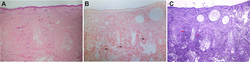 Figure 2 Three pathological images of nodular amyloidosis. (A) Deposition of acellular amorphous eosinophilic materials over the entire dermis and subcutis (H&E, ×200). (B) The amyloid deposits were positive for Congo red staining, and keratinous cysts were found in the superficial dermis. The arrows indicate the sites of amyloid deposits.(Congo red staining, ×200) (C) The amyloid deposits were positive for crystal violet staining, and keratinous cysts were found in the superficial dermis. The arrows indicate the sites of amyloid deposits. (Crystal violet staining, ×200).