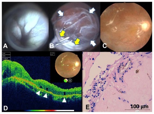 Figure 1 Intraoperative and postoperative view of a 61-year-old male with long-standing rhegmatogenous retinal detachment with epiretinal and subretinal proliferation. The preoperative visual acuity was counting fingers. He was diagnosed with posterior grade C12 and anterior grade C12 proliferative vitreoretinopathy (type 3: subretinal) and underwent pars plana vitrectomy with retinotomy for retinal turnover and retinal relaxing. (A) Intraoperative view. The retina lacked elasticity despite removal of epiretinal proliferative tissue. (B) Intraoperative view. The 360-degree retinotomy allowed for retinal turnover and removal of a diffuse sheet of subretinal proliferative tissue under direct visualization. Almost the entire subretinal space is covered with a diffuse sheet of subretinal tissue (white arrows) and the area at the lower left is the turned-over retina (yellow arrows). (C) Postoperative fundus photograph 4 months after surgery. (D) The postoperative spectral-domain optical coherence tomography image 3 months after surgery shows loss of the photoreceptor inner and outer segment junction and the external limiting membrane of the macula. White arrowheads show the migrated perfluorocarbon liquid. (E) Histopathological examination of the surgically excised subretinal tissue reveals fibrous connective tissue with pigmented cells. There are small epithelial cells with ovary-shaped nucleus, arranged in clumps (hematoxylin and eosin).