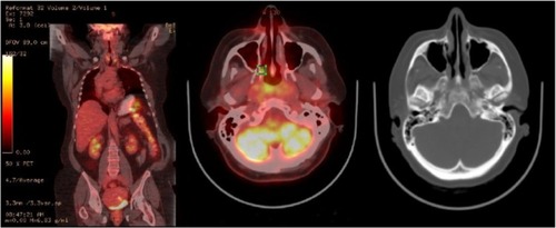 Figure 2 PET-CT scan showed inflammatory changes in the nasopharynx.