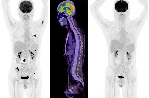 Figure 3 18F-FDG PET/CT maximum intensity projection (MIP) images and sagittal fused PET/CT images. Staging 18F-FDG PET/CT maximum intensity projection (MIP) image (left side) showing FDG-avid left lung, adrenal lesion and some bone metastases (left humerus, right iliac wing). Sagittal fused PET/CT image (middle image) showing no evidence of meningeal involvement. Follow-up PET/CT MIP image (right side) demonstrates near complete resolution of lung, adrenal and right iliac wing lesion as well as decreasing uptake in the left humerus.