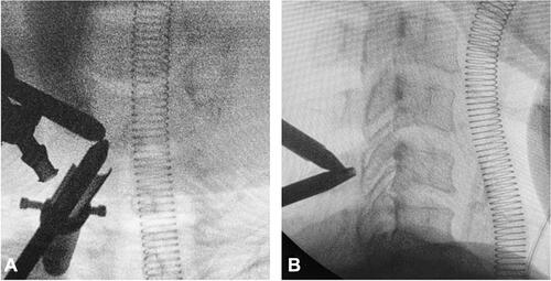 Figure 1 Marking the lamino-facet junction on affected level by image intensifier. (A) Anteroposterior view. (B) Inserting the obturator guided with lateral C-Arm image.