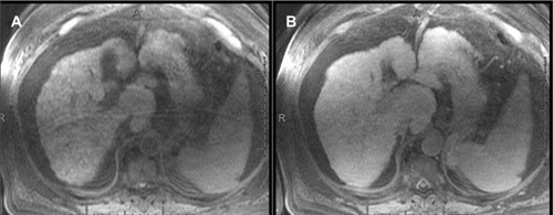 Figure 17 MRIs showing cirrhosis.