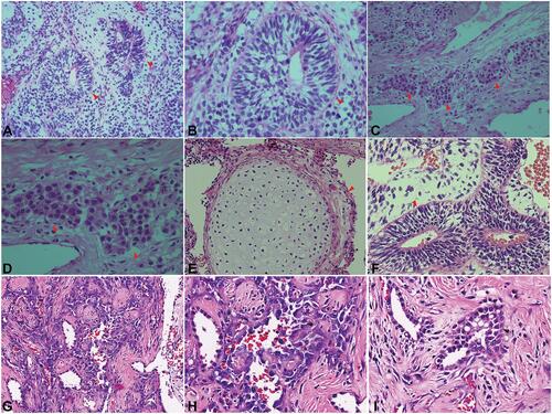 Figure 1 The morphology of hematoxylin-eosin staining mediastinal mass, including primary (A–F) and metastatic GCT (G–I). The primary mass contained seminoma (10%) and immature teratoma (90%) components. The seminoma cell was pleomorphic with abundant cytoplasm and distributed in clusters ((C–D), 200× and 400×). The components of immature teratoma mainly included immature neural tube ((A–B), 200× and 400×), cartilage ((E), 200×), and glands ((F), 400×). The metastatic mass was a mainly extensive deposition of osteoid connective tissue, surrounded by atypical epithelioid cells ((G), 200×, and (H–I), 400×). The neoplastic cells, featured with increased nuclear-to-cytoplasmic ratio and abnormal chromatin distribution, were arranged in irregular lacunar (H) and adenoid structures (I). The red or black triangles pointed to the corresponding structure. GCT, germ cell tumor.