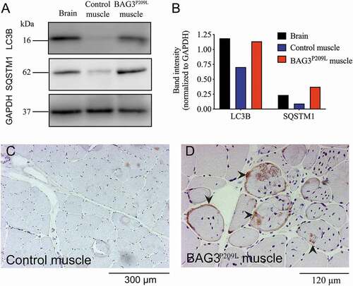Figure 5. Defective autophagy is evident in BAG3P209L myofibrillar myopathy patients. (A) Western blot for LC3 and SQSTM1 in control and BAG3P209L patient. Quantification of LC3 and SQSTM1 (B) reveals accumulation in a BAG3P209L patient but not in control muscle. Abnormal SQSTM1 accumulation (arrowheads) is observed in patient (D) muscle cells but not in control samples (C)