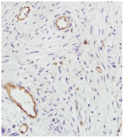 Figure 10 Histologic slice obtained from animal treated with endostar-loaded nanoparticles (CD-31staining, 400×). Vessels appear as dark cycle areas.