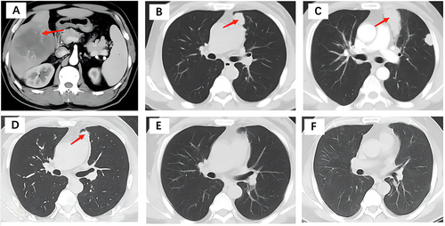 Figure 1 (A) The huge lump on the right lobe of the liver was surgically removed in April 2017. (B) The postoperative follow-up (May 2018) showed tumor recurrence in the lungs. (C) At the end of the last arsenic trioxide chemotherapy and before the use of tislelizumab (October 2018). (D) The efficacy was first evaluated as a partial response after 2 cycles of treatment with tislelizumab (January 2019). (E) The efficacy was first evaluated as a complete response after 12 cycles of treatment with tislelizumab (July 2019). (F) The patient still had a complete response at the latest follow-up (July 2023). The red arrow in Figure 1A indicates the location of the primary tumor. Arrows in Figure 1B, 1C and 1D indicate the location of recurrent tumors in the lungs.