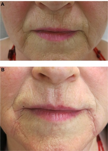 Figure 6 A 68-year-old woman with flattening of Cupid’s bow, thinning of white rolls, perioral fine lines, and marionette lines.