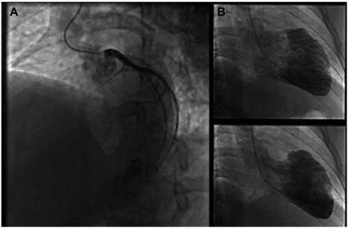 Figure 4 (A) LAO 45-cranial 25 view left coronary angiography: complete proximal LAD occlusion. (B) Left ventriculography revealing severe left ventricular systolic dysfunction and antero-apical akinesia. Right coronary angiography (not shown) was normal.