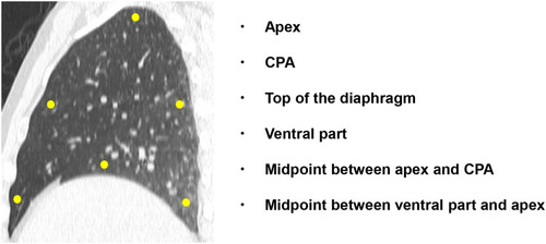 Figure 1 The measurement point of lung movement in our study.