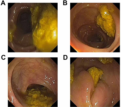 Figure 1 Quality of bowel preparation on December 27, 2022. No report only pictures because of the poor bowel preparation. (A and B) Right colon; (C): Transverse colon; (D) Left colon. The Boston Bowel Preparation Scale (BBPS) score for this session was recorded as 3. The score indicated the presence of unremovable solid feces, suggestive of inadequate bowel preparation.