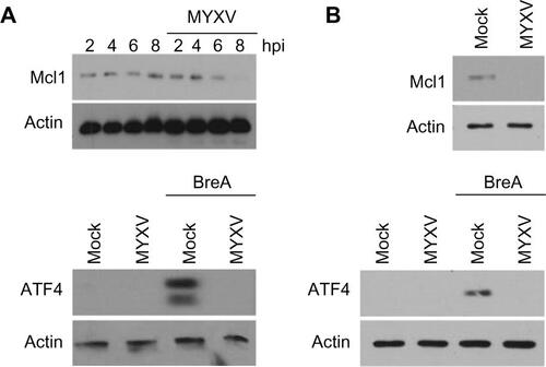 Figure S1 MYXV blocks ATF4 and Mcl1 expression in RPMI-8226 and MM.1S myeloma cells.Notes: (A) RPMI-8226 human MM cells were infected with MYXV at MOI =10. At the indicated time points, cells were harvested, and the expression of Mcl1 (top) or ATF4 (bottom at 6 hours) was analyzed using immunoblot. (B) MM.1S human MM cells were infected with MYXV at MOI =10. At 6 hours postinfection, cells were harvested, and the expression of Mcl1 (top) or ATF4 (bottom) was analyzed using immunoblot.Abbreviations: ATF, activating transcription factor; hpi, hours postinfection; MOI, multiplicity of infection; MM, multiple myeloma; MYXV, myxoma virus; RPMI, Roswell Park Memorial Institute.