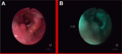 Figure 19 Pharyngeal lipoma, in white light endoscopy (A) and fluorescence (B) imaging.