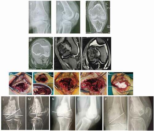 Figure 2. A 24-year-old female patient with Lt GCT distal femur (group II) with pathological fracture. (a and b) AP and lateral X-ray of Rt knee showing osteolytic lesion affecting medial femoral condyle with pathological fracture. (c and d) Coronal and axial CT delineating the fracture pattern and cortical thinning of the condyle. (e and f) Coronal and axial T2-weighted MRI showing isointense lesion with intralesional fluid signals of hemorrhage without soft tissue extension. (g and h) Intraoperative photos showing extended curettage. (i-k) Intraoperative photos showing fixation of fracture with 2 k-wires with subchondral iliac bone graft and cement. (l and m) AP and lateral x-ray of Rt knee immediately postoperative. (n and o) AP and lateral X-ray of Rt knee at the end of follow-up period showing full incorporation of bone graft and no evidence of recurrence. (p and q) AP and lateral x-ray of Rt knee; the prominent k wire was painful, which requires its removal.