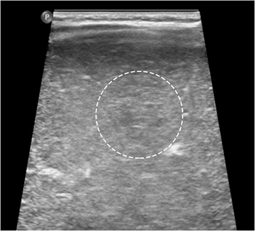 Figure 9 By the seventh month of treatment, the mass had shrunk to a 0.5 cm echogenic area. The white circle indicates the location of the hepatic hemangioma.