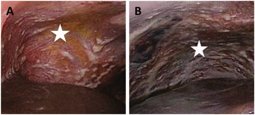 Figure 2. Irresectable peritoneal metastasis (white stars) in right upper abdomen (A) and left upper abdomen (B).