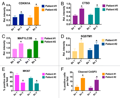 Figure 5. Quantification of the effects of treatment with HCQ and VOR on the expression of CDKN1A (A), CTSD (B), MAP1LC3B (C), SQSTM1 (D), MKI67 (E), and active CASP3 (F). *Indicates a significant change from baseline, P < 0.05.