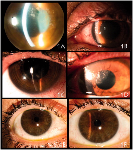 Figure 1. (A) Left eye episode diagnosed and treated as archipelago keratitis in 2007, with multiple microabscesses in the supero temporal cornea. (B) December 2009, left eye showing ulcerative blepharitis with superior lid oedema, erythema and erythematous macular lesions on the superior nasal lid skin; conjunctival hyperemia; multiple anterior stromal microabscesses situated on the superior nasal cornea and one infiltrate positioned in the inferior corneal; stromal diffuse infiltration and oedema. (C) November 2012, right eye showed mild conjunctival hyperemia, and 3 anterior stromal infiltrates associated with mild anterior diffuse stromal infiltration. (D) November 2012, her left eye showed superior lid oedema and an erythematous superior nasal lid lesion, meibomitis, and conjunctival injection. The left cornea presented with multiple stromal infiltrates positioned in the supero nasal cornea moving away from the limbus with a convexity border. (E–F) June 2013, right and left eyes showing eyelid margin without inflammation and cornea without scarring or corneal neovascularization (barely perceptible paracentral scarring, on both eyes, detected in 2009, are not seen in the pictures).