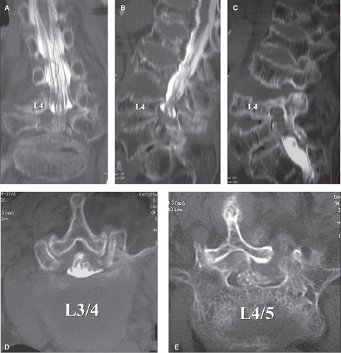 Figure 1. A 69-year-old women, with right L4 radiculopathy as revealed by postmyelographic CT scan. A: In the coronal section, bilateral L4 roots were well depicted. B: In the sagittal section, osteoporosis is evident; multiple vertebral collapse and end-plate irregularity are observed despite no history of trauma. C: In the sagittal section through the right foramen, foraminal stenosis is not obvious. D: In the transverse section (L3/4), spinal canal stenosis is very mild. E: In the transverse section (L4/5), prominent L4/5 facet joint destruction and lateral dislocation are noted.