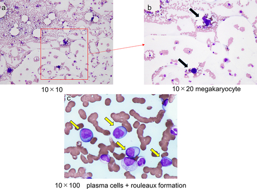 Figure 1 The bone marrow aspiration. (a and b) The bone marrow is hyperplastic, with an increase in megakaryocytes. Cells at various stages of maturation in all three lineages are observed. No obvious atypical epithelial cells are noted. (c) There is an increase in plasma cells.