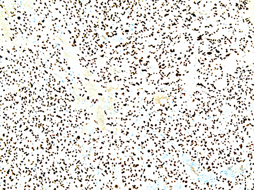 Figure 3 Specific nuclear positivity for TTF-1 in thyroid follicles.