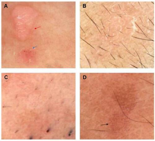 Figure 5 Different patterns of flat warts under the Dermoscope. (A) dotted vessels on red-white back ground (blue arrow) and dotted vessels on red-white back ground with some bleeding spots (red arrow), (B) dotted vessels whitish (pale) background, (C) dotted vessels whitish (pale) background, (D) dotted vessels on a red-gray background (black arrow).