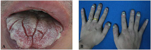 Figure 2 Patient No.2 (A) Image of oral mucosal of the father of the patient No.1 (B) Image of fingers of the father of the patient No.1.