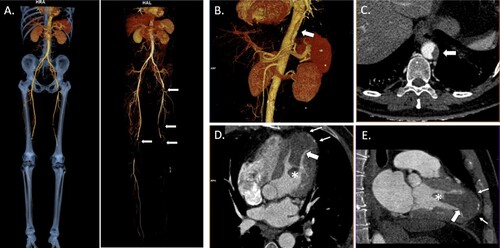 Figure 1. Three-dimensional reconstruction and computed tomography angiography (CTA) images of post-COVID-19 heparin-induced thrombocytopenia. (A) CTA three-dimensional image of multiple acute bilateral arterial thrombi (arrows) in the lower extremities suggesting thromboembolic origin with occlusion of the left popliteal artery. It is remarkable that there is no significant pre-existing aortic atherosclerosis. Three-dimensional reconstruction (B) and axial CTA (C) images showing a non-occlusive mural thrombus in the thoracoabdominal aortic hiatus. Four-chamber (D) and two-chamber views (E) revealing the presence of a large thrombus (65×32×34 mm) with a mobile distal pedicle (*) in the peripherally calcified apical left ventricular aneurysm (small arrows).