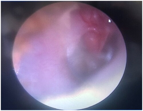 Figure 1. Otoendoscopic image of right tympanic membrane. White pointer denoting a lesion present in the pars flaccida extending inferiorly to the posterior and superior pars tensa.
