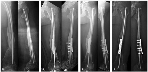 Figure 3. a. 15-year-old female with OI type III, treated with bisphosphonates, ambulatory with multiple fractures over a pre-existing flexible nail.b. Lateral closing wedge at the CORA, 4.5 mm flexible nail together with 6-hole 3.5 mm locking plate for length and rotational stability.c. Union without recurrent fractures or deformity at 2 months’ follow-up.d. Union without recurrent fractures or deformity at 2 years and 5 months’ follow-up.