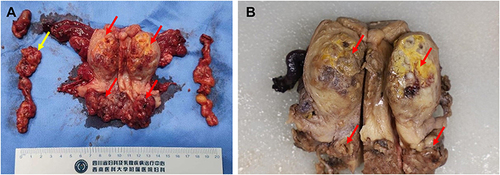 Figure 6 Macroscopic view of the uterus, bilateral adnexa and bilateral pelvic lymph nodes. The yellow arrow indicates the involved lymph nodes (A). The red arrow indicates the tumor’s original location (A and B).