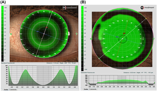 Figure 7 Ortho-k (A) and scleral lens (B) fitting simulation.