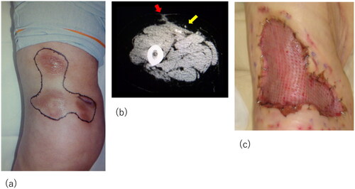 Figure 2. Recurrent lesion in the middle of the right thigh. (a) The lesion in the middle of the right thigh; obvious nodules with redness are marked. (b) Computed tomography images of the lesion: yellow arrow indicates the calcification in the muscle and red arrow indicates inflammation spreading towards subcutaneous tissue. (c) Meshed split-thickness skin graft taken successfully.