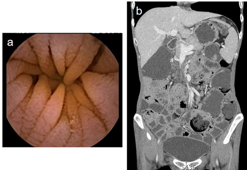Figure 2 (a) Capsule endoscopy showing mucosa of the jejunum in patient 2, which were thinned out and the intestinal villi were blunting. (b) CTE of the intestine in patient 2 showed multiple enlarged lymph nodes in mesentery and colon dilation.
