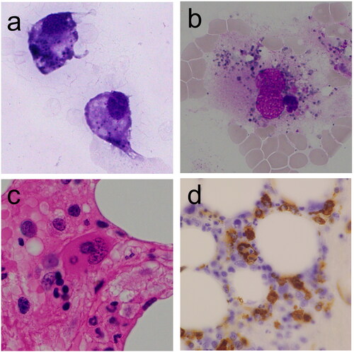 Figure 1. Hemophagocytic macrophages were seen in (a) cerebrospinal fluid and (b, c, d) bone marrow. (a) Cerebrospinal fluid, Giemsa staining, ×1000, (b) Bone marrow aspiration smear, May Giemsa staining, ×1000, (c) Bone marrow trephine biopsy, Hematoxylin-eosin staining, ×400, (d) Bone marrow trephine biopsy, CD68 staining, ×60.