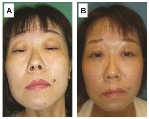 Figure 1 (A) Preoperative view of the patient with ptosis shows that she has a prominent wrinkle in her forehead and sticks out her chin when she tries to open her eyes. (B) Postoperative view shows that the eyelids are symmetrical and in the appropriate position 1 year after the operation.