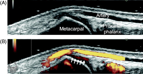 Figure 3. Representative images of reverberation mimicking synovial Doppler signals. Dorsal aspect of the left first metacarpophalangeal joint, longitudinal view. (A) gray-scale image and (B) power Doppler image. Arrows indicate reverberation on the hyaline cartilage due to superficial artery (see also Video 22).