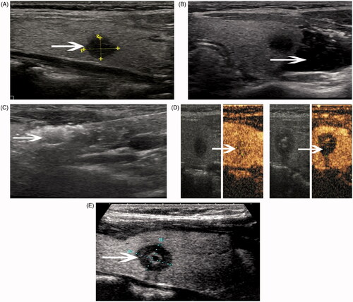 Figure 4. A 48-year-old woman (Patient 11) had a papillary carcinoma in the left lobe of her thyroid gland. The key procedure of the MW treatment is shown here, and the changes in the volume of the tumour before MW ablation and at 1-month follow-up are also presented. (A) Before the ablation, ultrasound examination with ultrasound-guided biopsy confirmed the tumour as papillary thyroid carcinoma 96 mm3 in volume, with inhomogenous internal echoes and microcalcification. (B) Under local anaesthesia a mixture of 0.9% lidocaine and physiological saline was infused into the surrounding thyroid capsule to achieve a ‘liquid isolating region’ (arrow) protecting the vital structures of the neck (carotid artery, oesophagus, nerve) from thermal injury. (C) Under the guidance of ultrasound, a thyroid-dedicated cooled shaft antenna was positioned in the tumour. A sonogram obtained during treatment shows the typical hyperechoic region (arrow) surrounding the antenna. (D) For the PTMC, we achieved slightly more necrosis than the preoperation nodule, evaluated with the contrast-enhanced ultrasound just at the end of each procedure. (E) At follow-up ultrasonography examination 1 month after treatment, the nodule exhibited change to a hypoechoic nature, with a pin site hyperechoic inside (arrow) and a little larger in size (121 mm3 in volume).