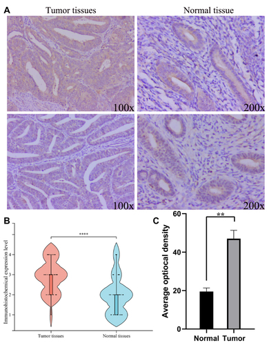 Figure 3 Solute carrier family 7 member 11 (SLC7A11) expression of Uterine corpus endometrial carcinoma (UCEC) tissue and the corresponding paracancerous tissue. (A) The expression level of SLC7A11 in UCEC and noncancerous tissues by immunohistochemistry. (B) SLC7A11 expression was high in 35 UCEC tissues than in the corresponding normal tissues by immunohistochemistry. (C) SLC7A11 expression was high in 10 UCEC tissues than in the corresponding normal tissues by quantitative real-time polymerase chain reaction (qRT-PCR).