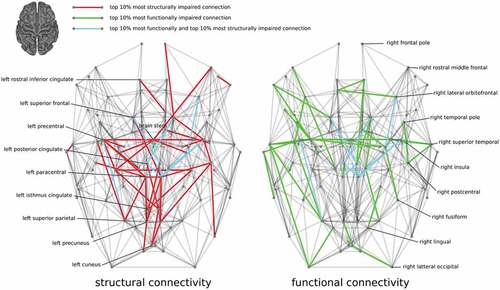 Figure 2. Overlap between changes in structural and functional connectivity in ALS. Connectomic representation of the brain network in which the top 10% most impaired SC connections (left) and the top 10% most impaired FC connections (right) as well as the overlapping connections are colored. The locations of homologous nodes, based on anatomy, have been symmetrized. Reprinted from [Citation56] with permission of John Wiley and Sons.