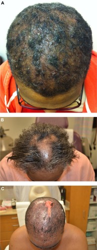 Figure 3 Scarring Alopecias.