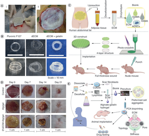 Figure 3. Design and bioprinting of multimaterial dECM-containing bioinks for skin tissue engineering.(A) Manipulation of the bioprinted dECM patch (i) and its ability to fit to the wound bed (ii). (B) Effect of gelatin incorporation on the printability of dECM inks and comparison to Pluronic F 127 ink (scale bar: 10 mm). (C) Schematic illustration of the design, bioprinting and implantation of ADSCs-laden ECM–GelMA–HAMA constructs. (D) Macroscopic images of the wound size after treatment with Alg/gel and 5%ECM-Alg/gel 3D printed scaffolds during 21 days upon implantation. (E) Schematic illustration of the process of fabrication of the skin model of hypertrophic scar.ADSC: Adipose-derived stem cells; Alg: Alginate; dECM: Decellularized extracellular matrix; ECM: Extracellular matrix; GelMA: Gelatin-methacryloyl; HAMA: Methacrylated hyaluronic acid; PCA: Preformed cellular aggregates.Modified with permission from [Citation7,Citation14,Citation79,Citation161,Citation162].